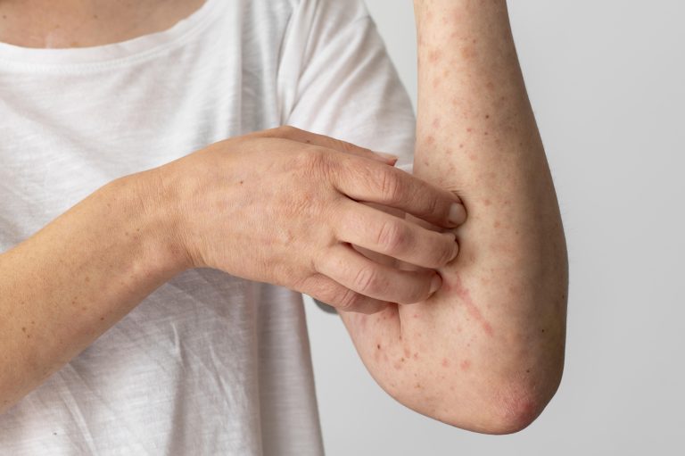natural treatment eczema