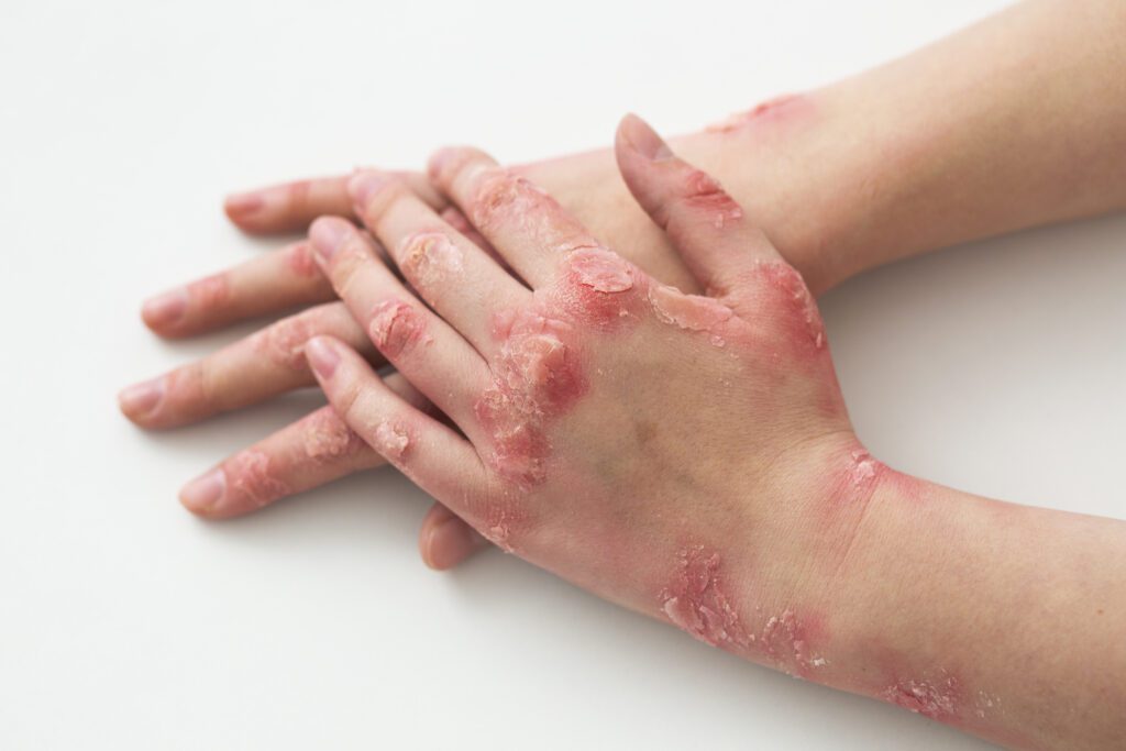 What Is Eczema?