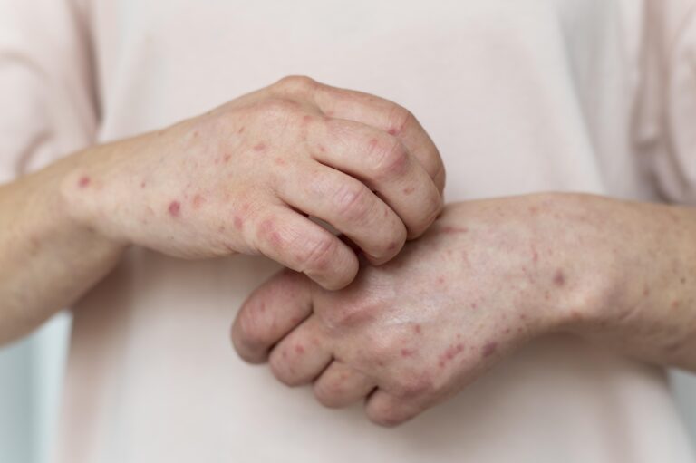 Struggling with eczema flares during stressful times? Discover the powerful stress-eczema connection. Dr. Luis explains how stress impacts your skin and shares naturopathic tips to find relief.